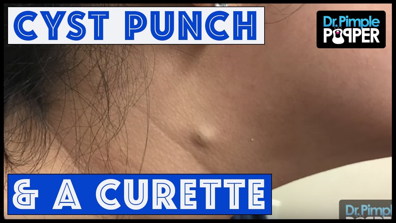 Cyst Punch & Curette