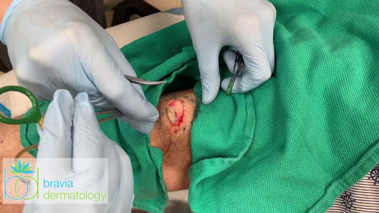 Cyst removal above the knee… without the pop
