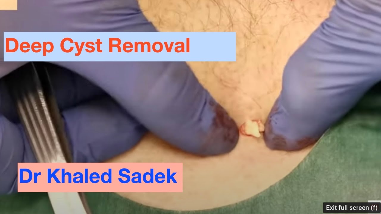 Cyst Removal. Dr Khaled Sadek. LipomaCyst.com