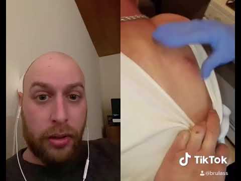 Cyst removal in the kitchen!