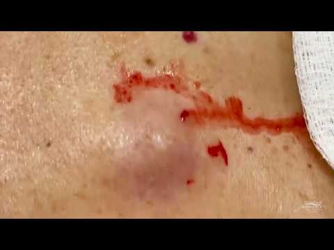 Cyst Removed like Runny Eggs
