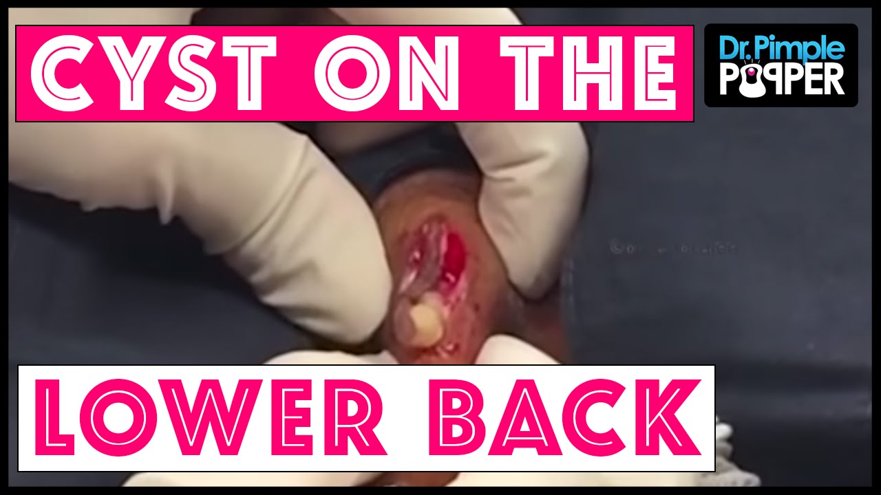 Cyst Removed on the Lower Back, filmed with Buzzfeed present