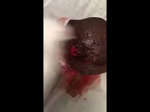 Cyst Shower