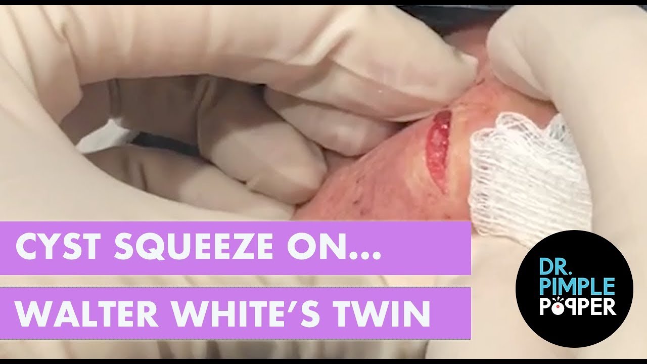 Cyst Squeeze on Walter White’s Twin