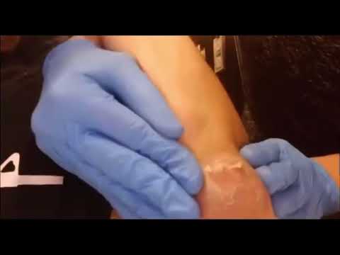 Cyst Super Soaker! Cyst popping elbow video