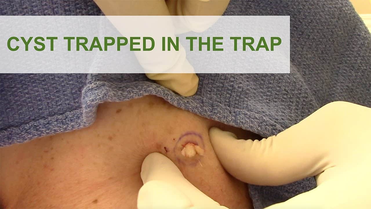 Cyst Trapped in the Trap | Dr. Derm