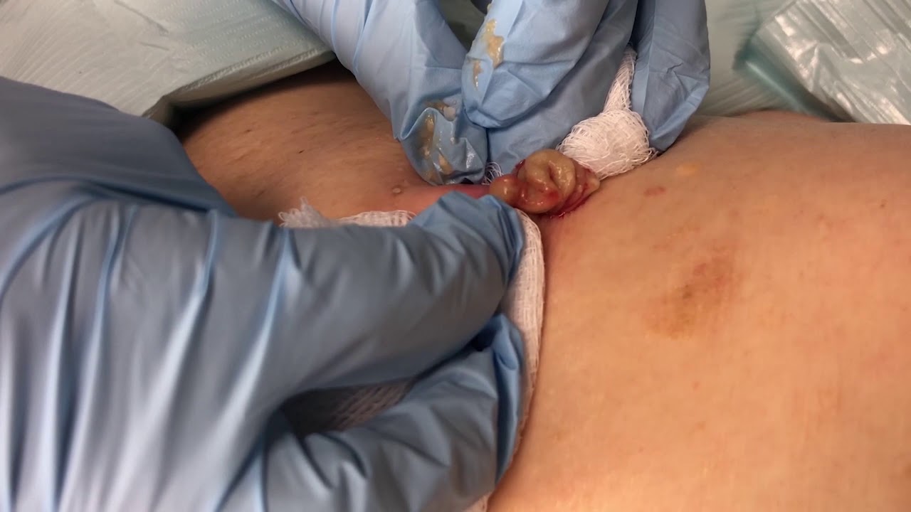 Cyst Video