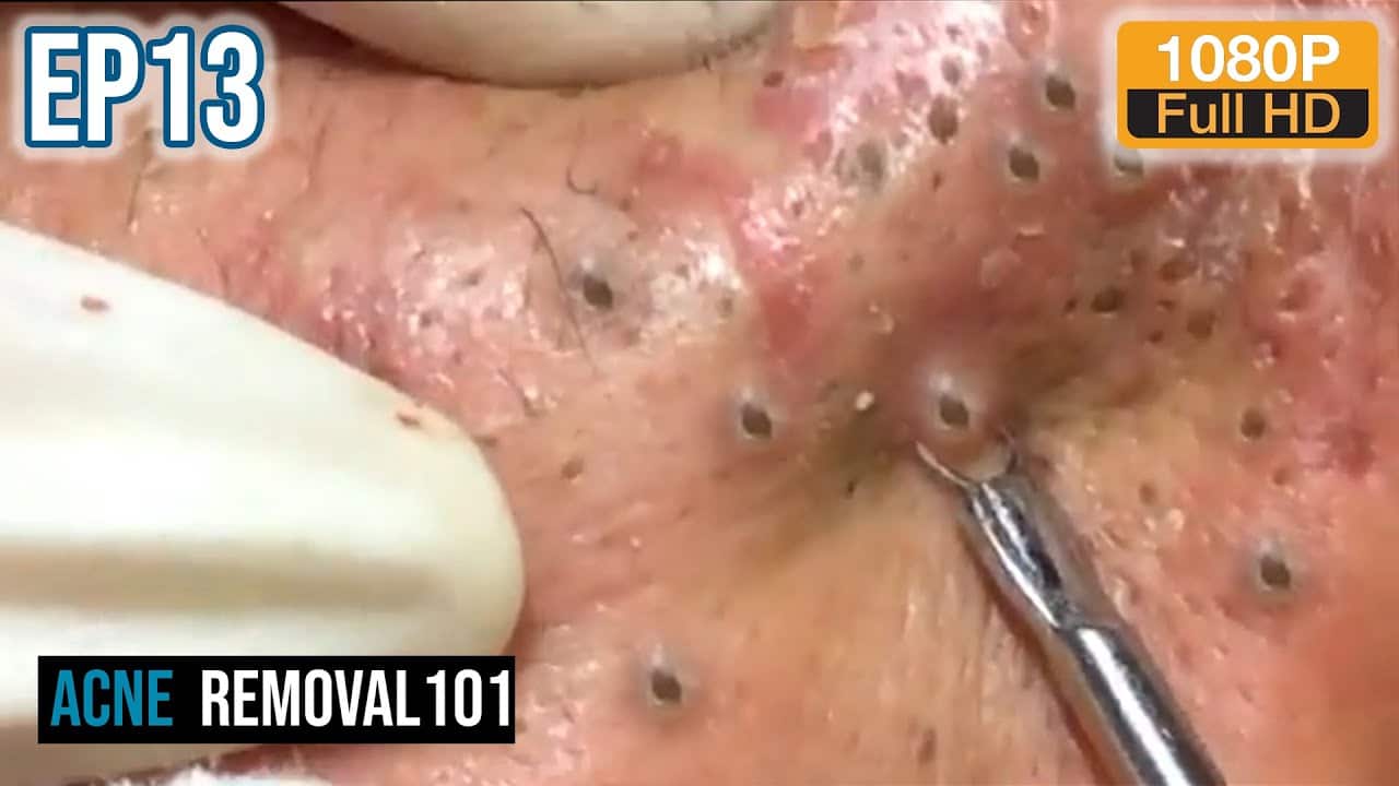 Cystic Acne Extraction 32mn , Blackheads Removal by ACNEREMOVAL101