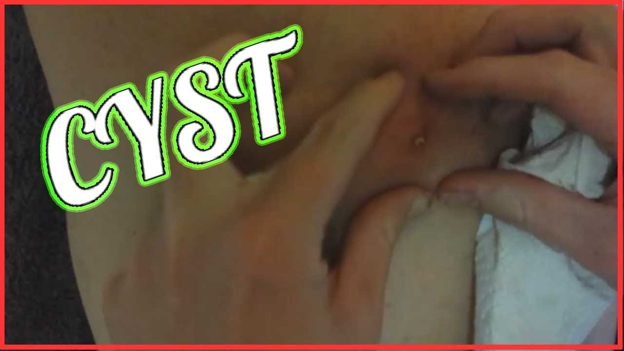 Cystic acne extraction. Cyst popping on back – Pimples and dermatology