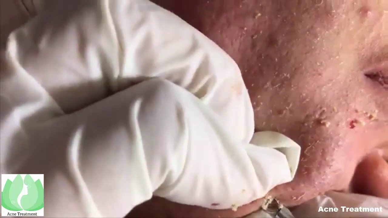 Cystic Acne Extraction Cyst Popping on Face All pimples | Face Infection