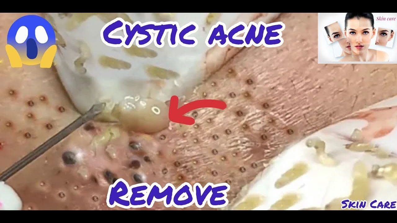Cystic Acne Extraction This Week, Blackheads Removal , Pimple popping #6