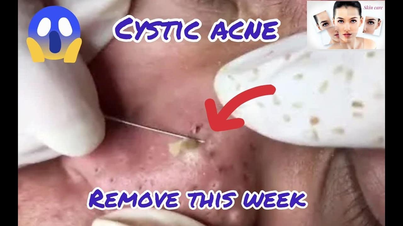 Cystic Acne extraction this week , Blackheads remove pimple popping #23