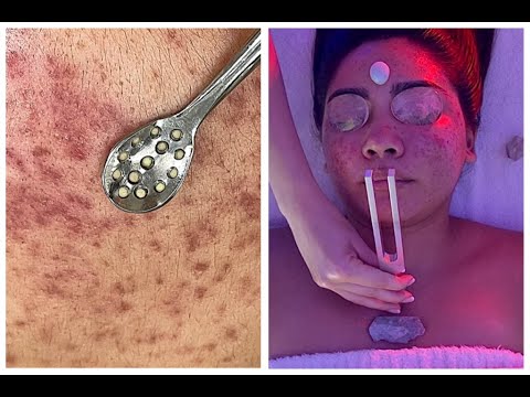 Cystic Acne Facial: Pimple Removal, Lighten Scars, Deep Relaxation {ASMR}