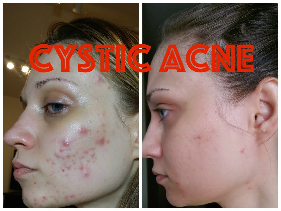 Cystic Acne – How I got rid of it!