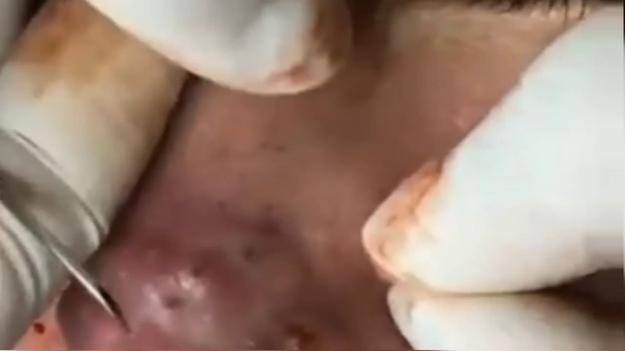 Cystic acne on nose