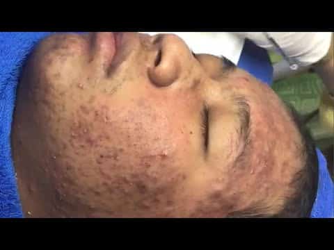 Cystic acne, pimple popping, blackhead extraction, whitehead extraction Part1