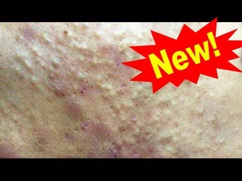 Cystic Acne, Pimples And Blackheads Extraction Acne Treatment On Face!!! Part 19