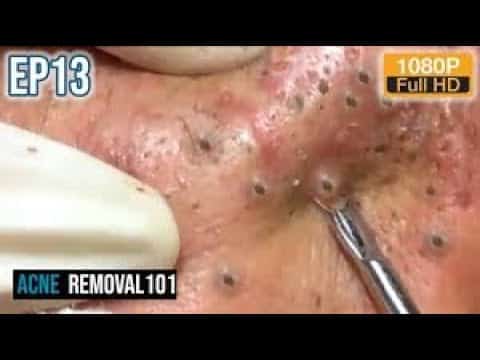 cystic acne removal,loan nguyen,blackheads 2020,pimple popping,acne extraction ,blackhead extraction