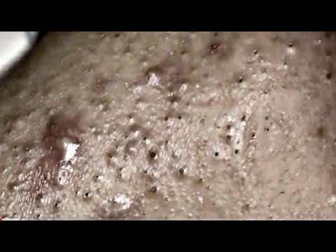 cystic acne treatment, big acne removal compilation