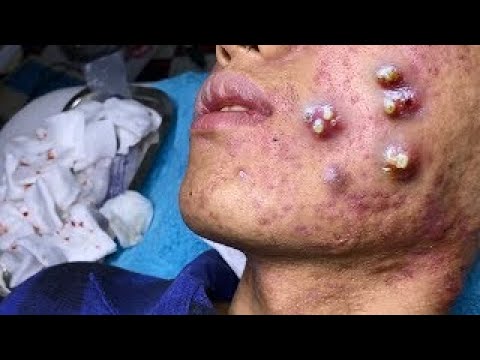 Cystic Acne Treatment / Cyst and Blackhead extraction / Pimple Popping / Clogged Pores #4