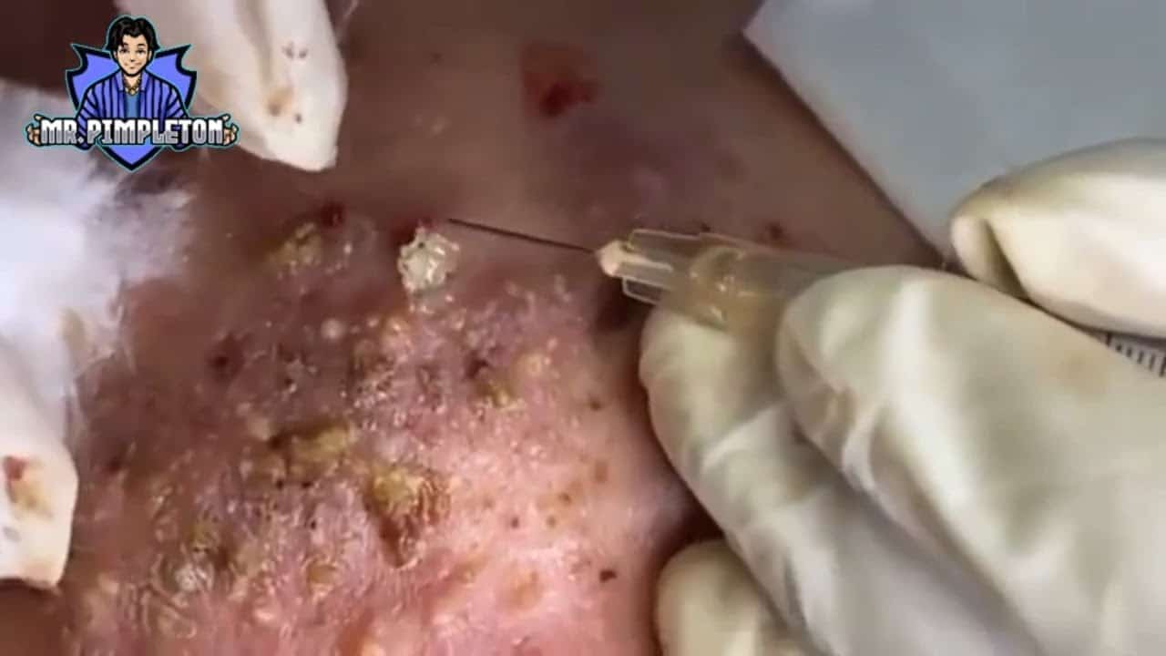 Cystic Acne Treatment / Cyst and Blackhead extraction / Pimple Popping / Clogged Pores #3