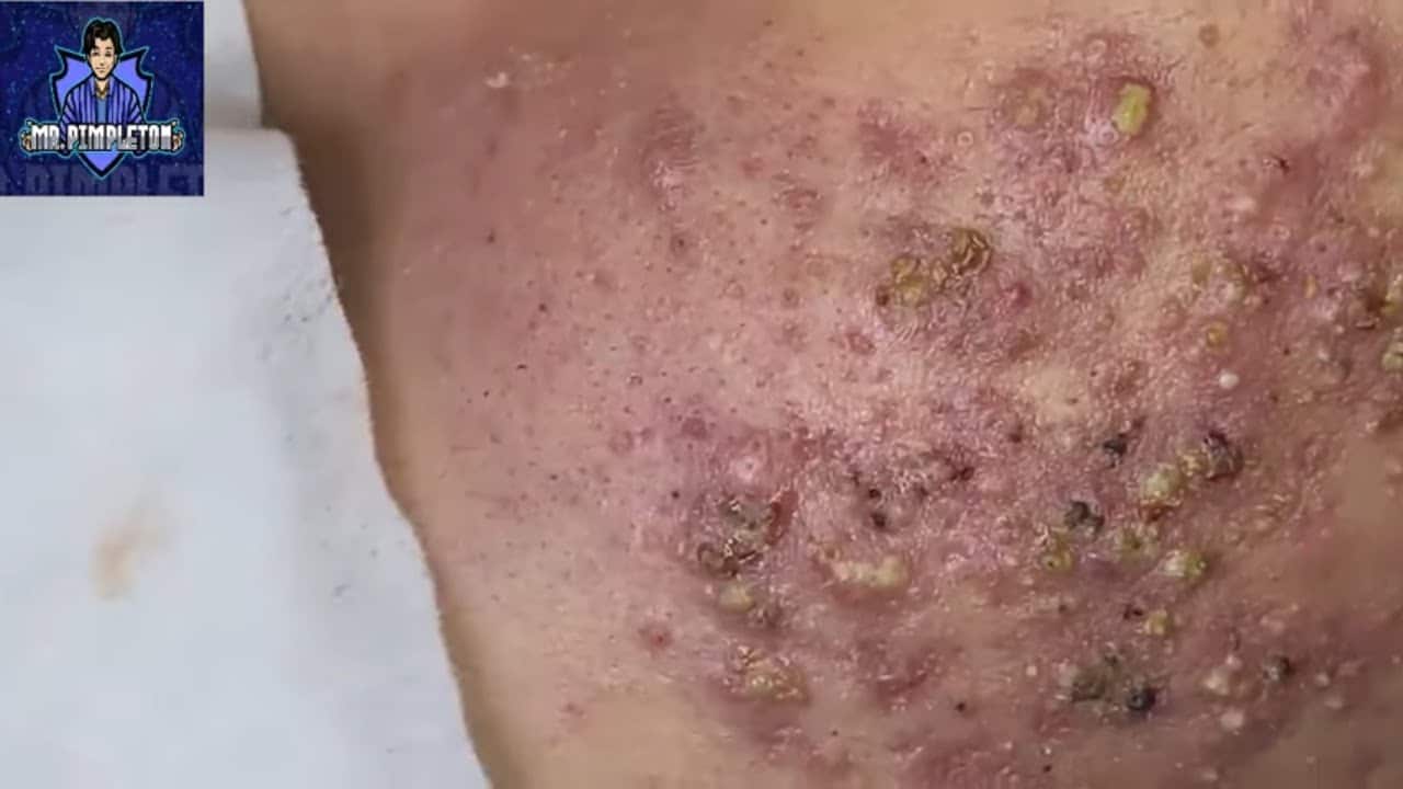 Cystic Acne Treatment / Cyst and Blackhead extraction / Pimple Popping/ Clogged Pores #3 Treatment 2