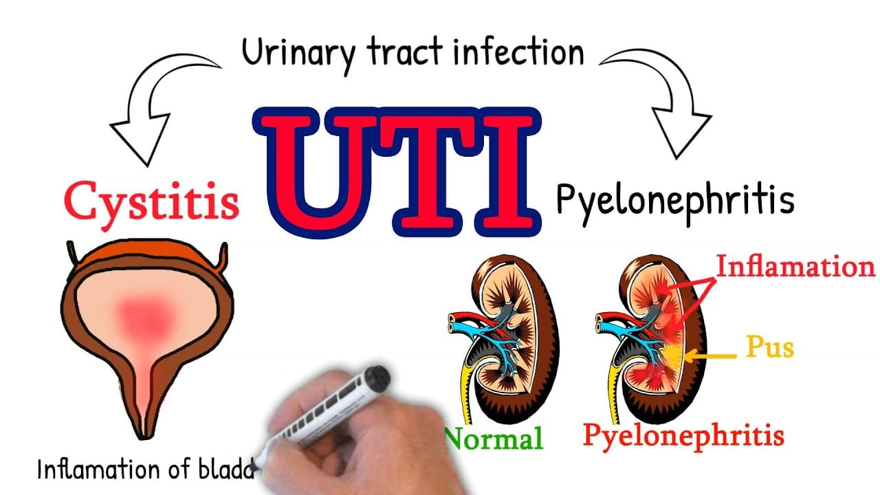 Cystitis – made simply.  UTI: Cystitis vs pyelonephritis