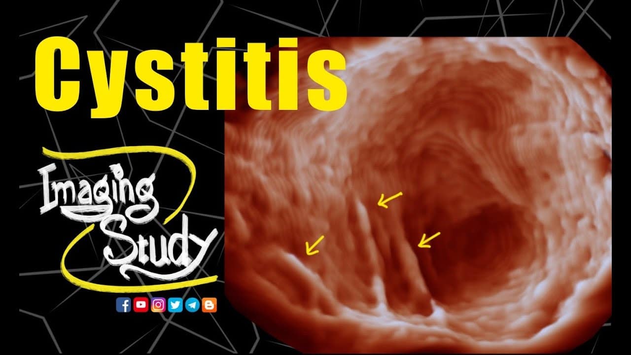 Cystitis || Ultrasound || 3D || Case 228