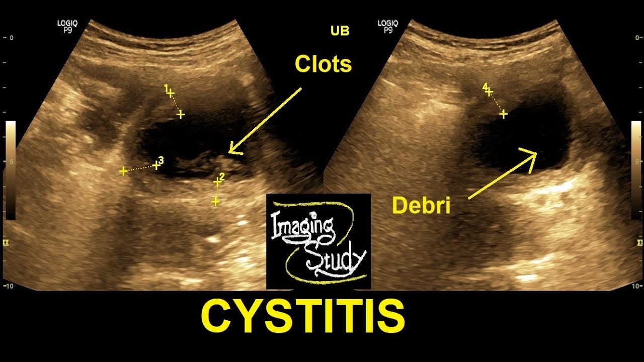 Cystitis || Ultrasound || Case 29