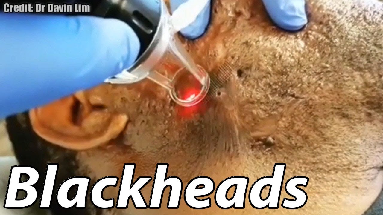 Cysts, Blackheads, Lipomas & Bizarre Medical!  Best Of Popping