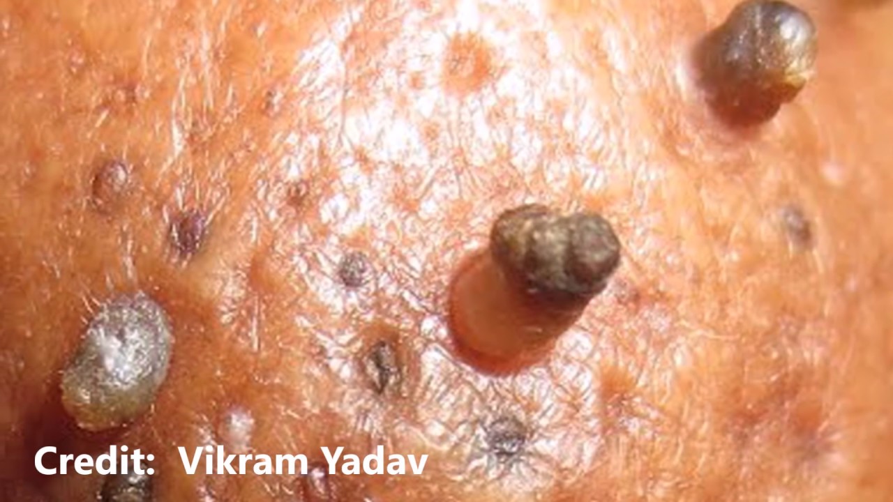 Cysts, Blackheads, Warts, Popping and Warts!  Medical TRIVIA