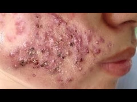 Cysts, Ingrown Hairs, Pimple Popping & Zits & Popping