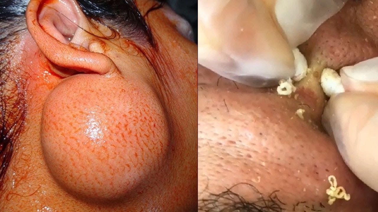 Cysts, Pimple Pops and Blackheads