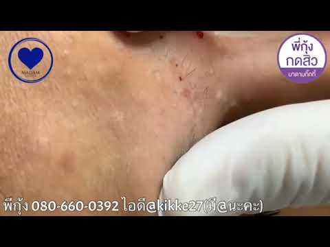 cysts popping at home
