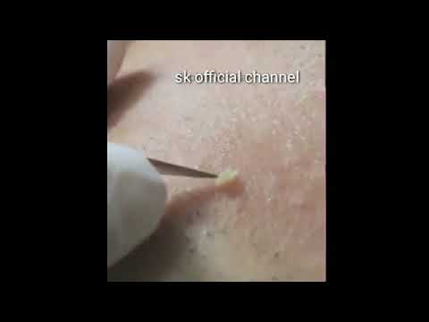 cysts popping at home