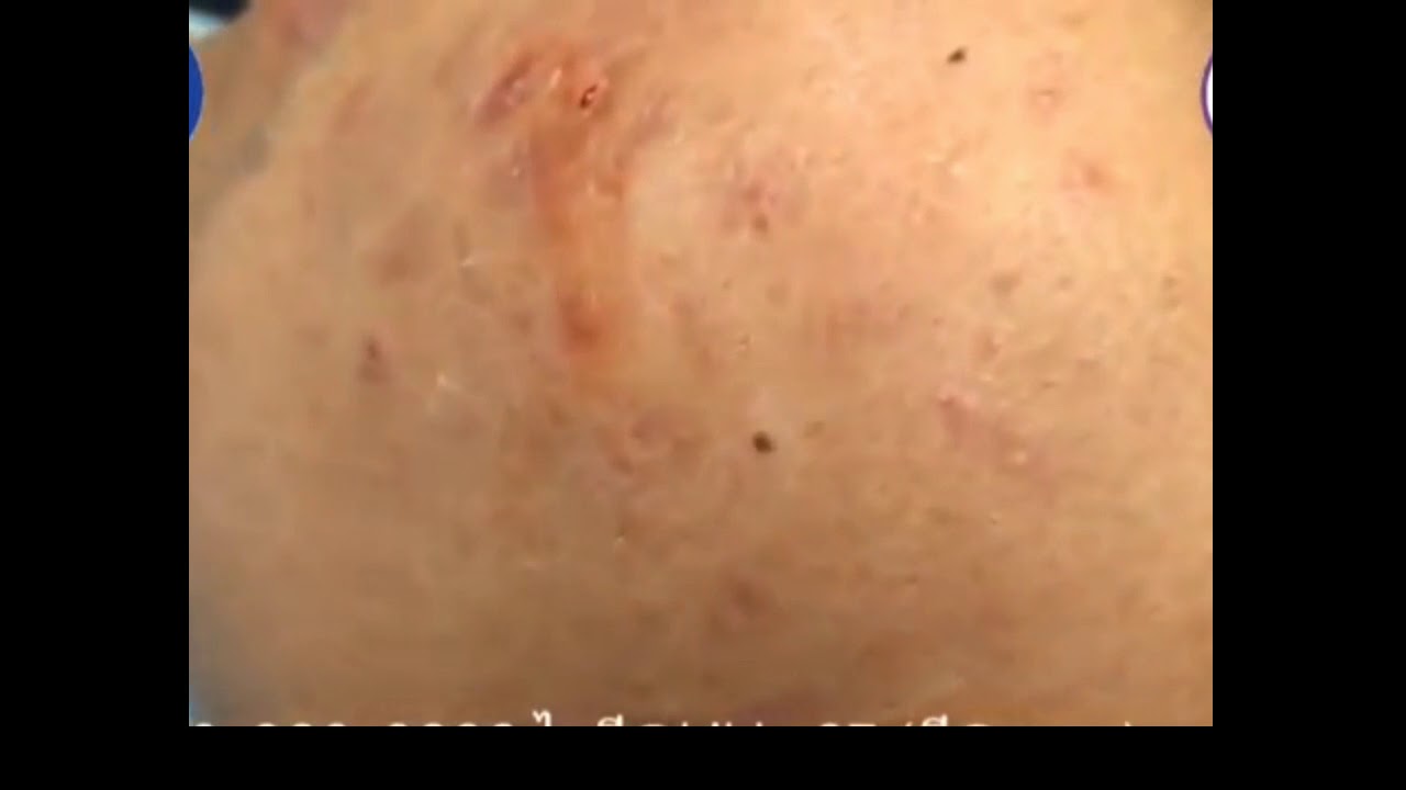 cysts popping at home 2019