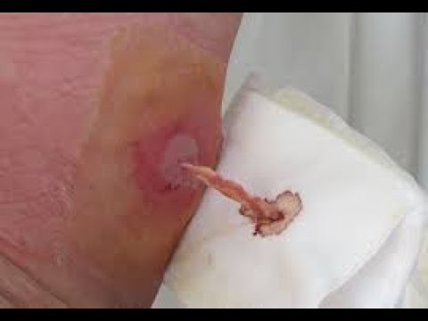 cysts popping compilation