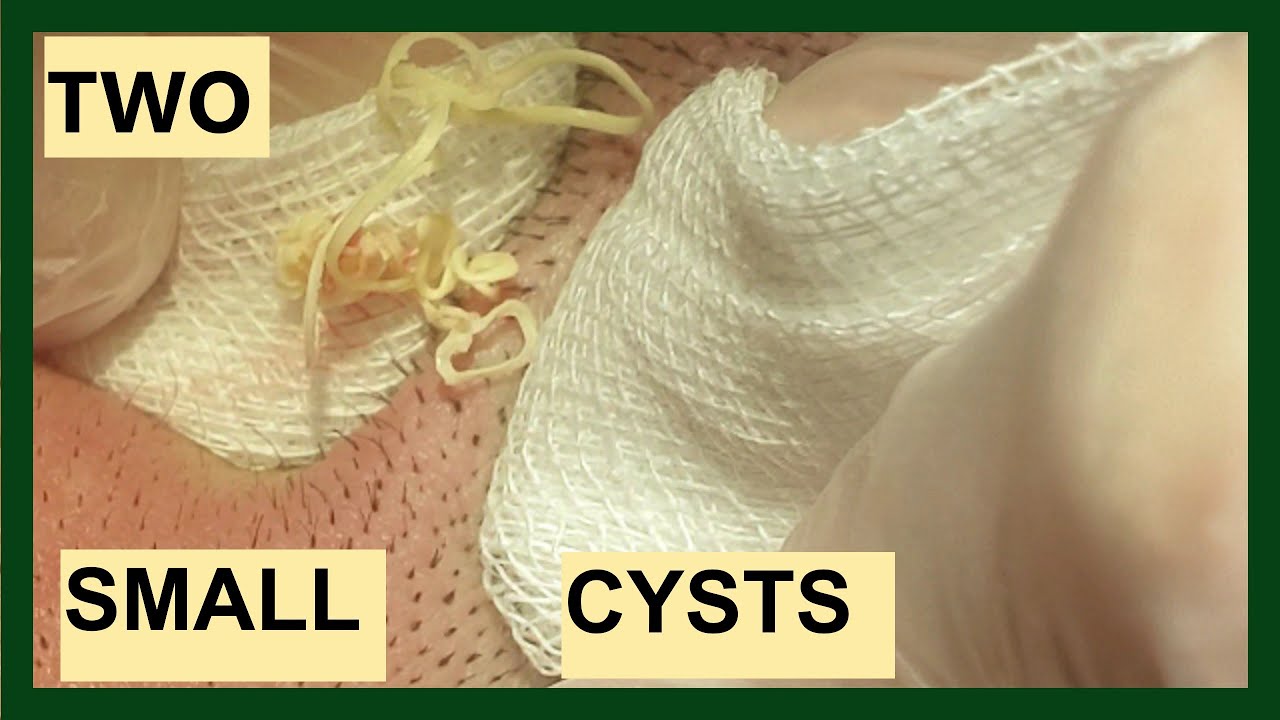 CYSTS REMOVAL – (With CAPSULES)