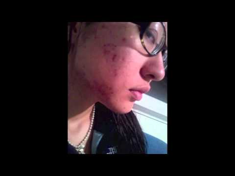 Daisy Jing @daiserz89 founder CEO Banish before she started Banish acne photos acne scar