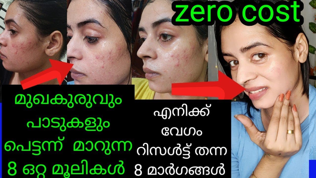 DAY-9 Acne and pimple spots Remove Natural Remedy|8 traditional remedies for Acne and spots