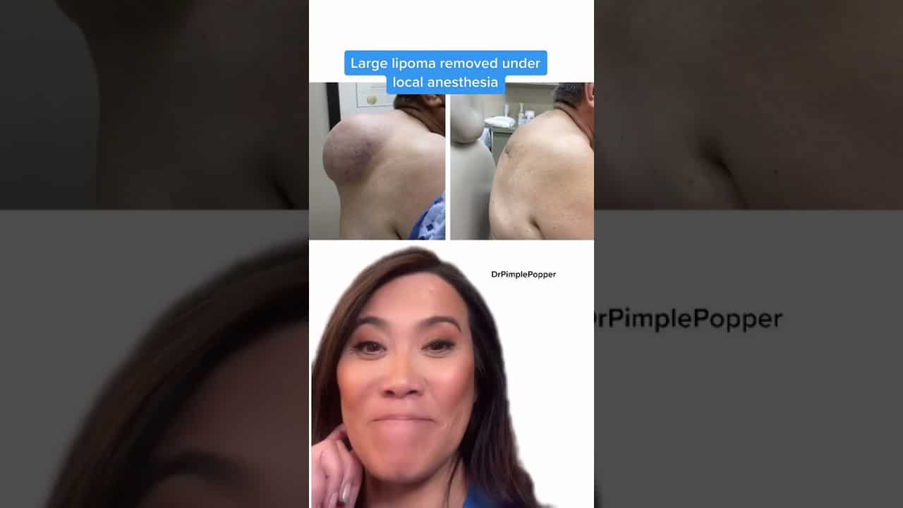 Days in my life as DrPimplePopper… #shorts #boardcertifieddermatologist #drpimplepopper #dermatology