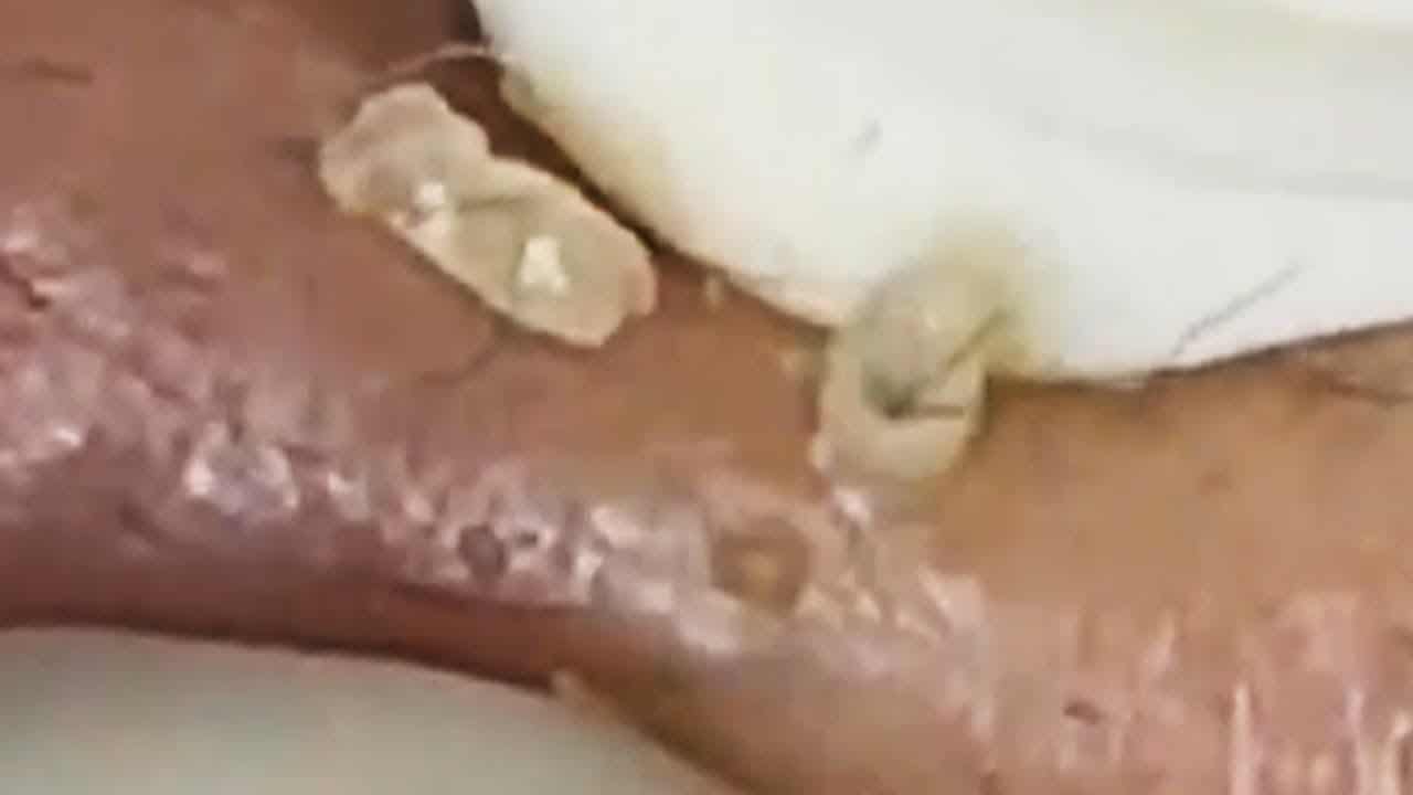 Deep blackhead extraction Cystic acne & pimple popping #101