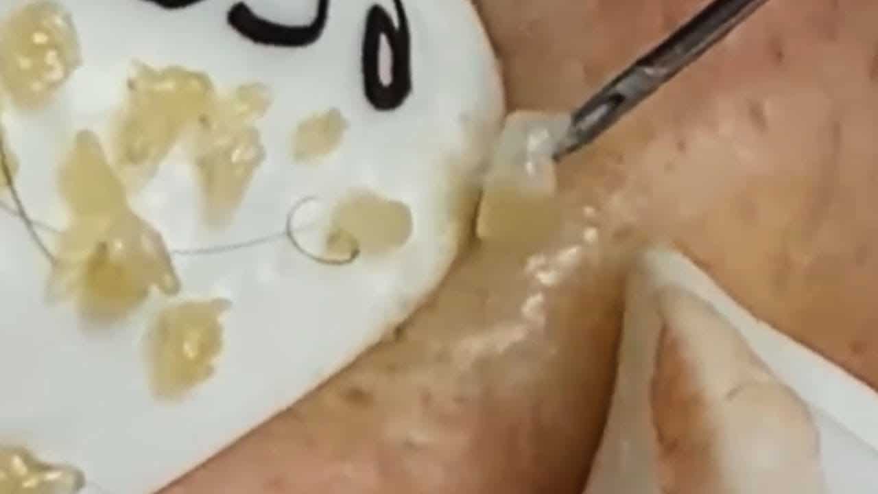 Deep blackhead extraction Cystic acne & pimple popping #100