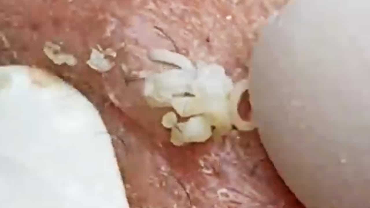 Deep blackhead extraction Cystic acne & pimple popping #98