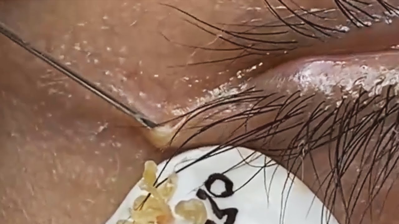 Deep blackhead extraction Cystic acne & pimple popping #95