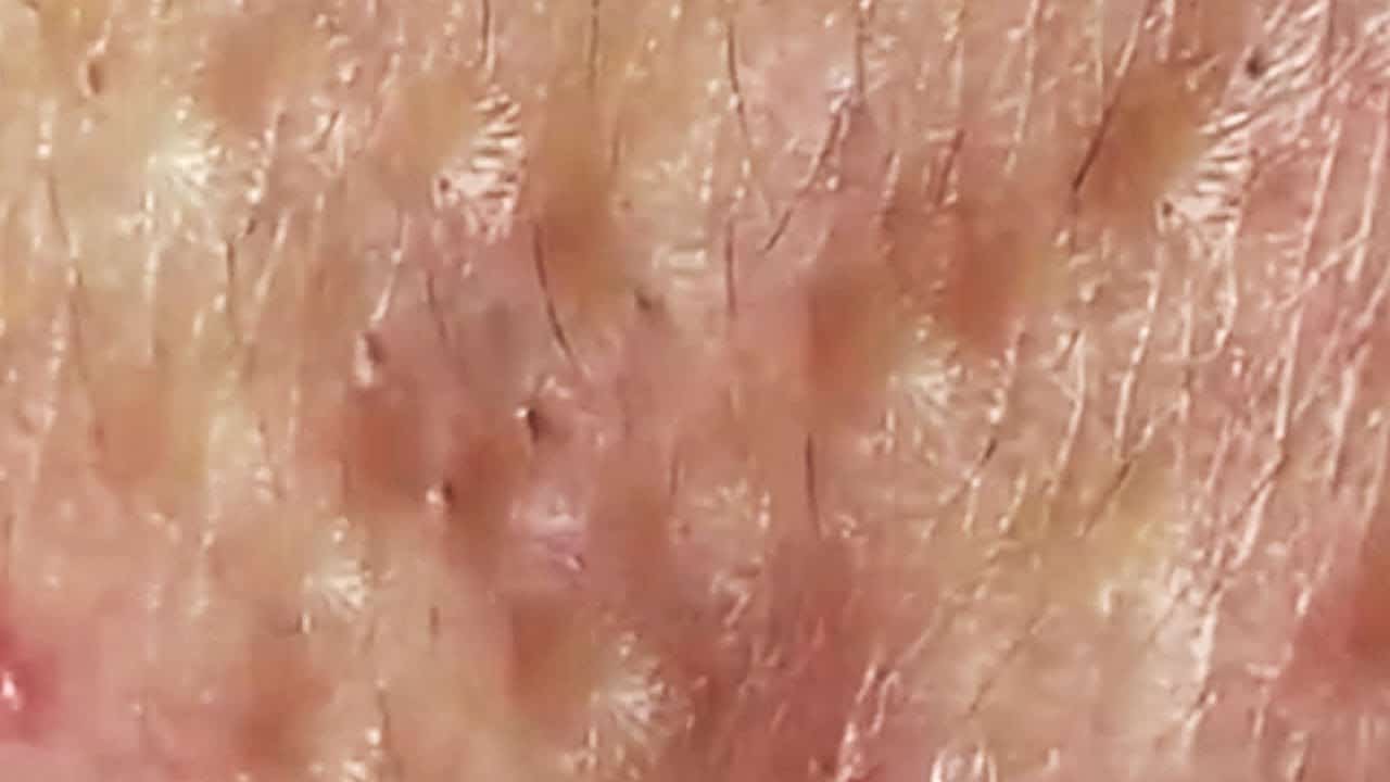 Deep blackhead extraction Cystic acne & pimple popping #79