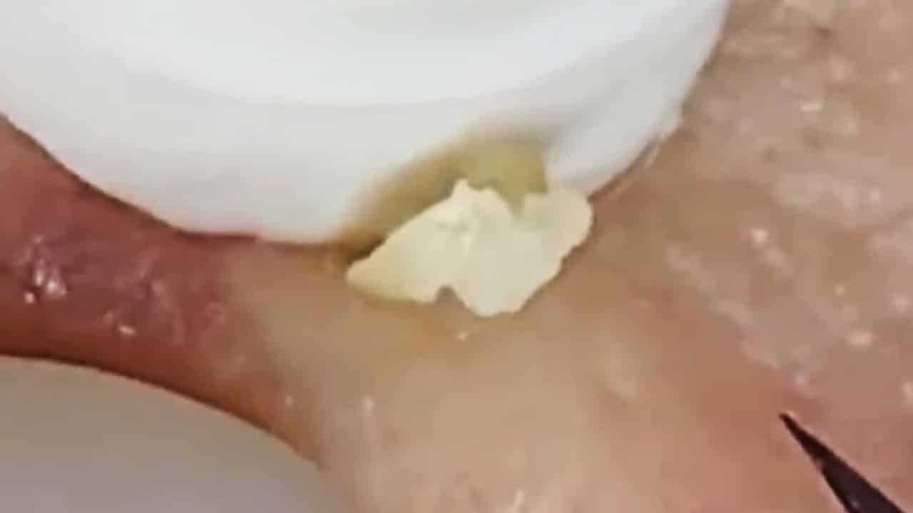 Deep blackhead extraction Cystic acne & pimple popping #69