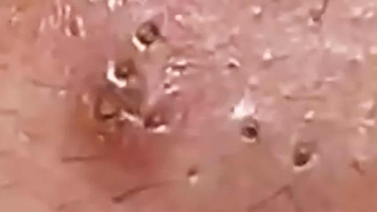 Deep blackhead extraction Cystic acne & pimple popping #64