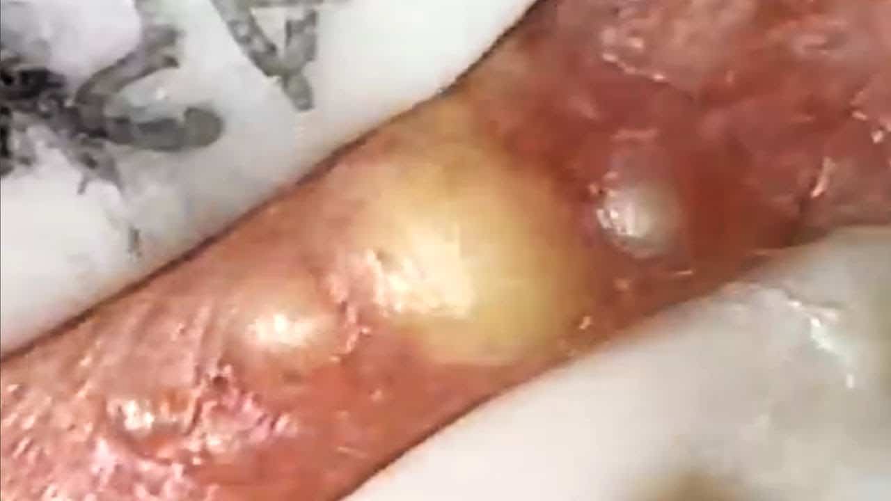 Deep blackhead extraction Cystic acne & pimple popping #54