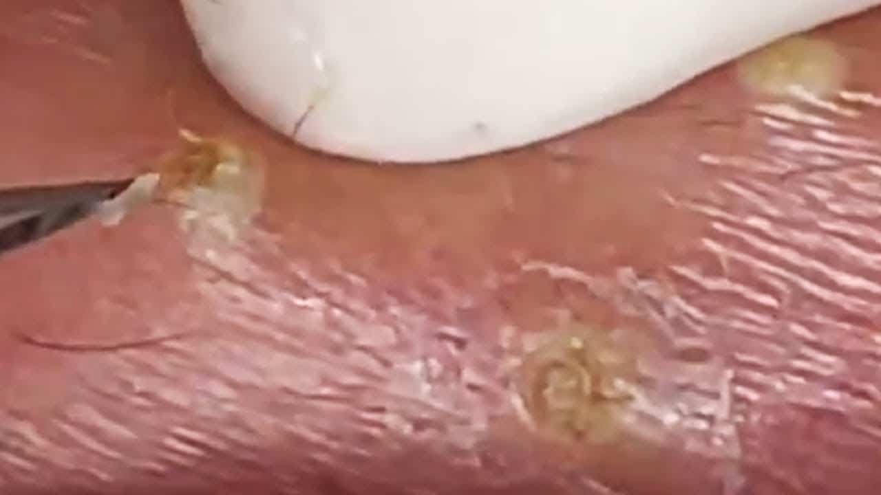 Deep blackhead extraction Cystic acne & pimple popping #52
